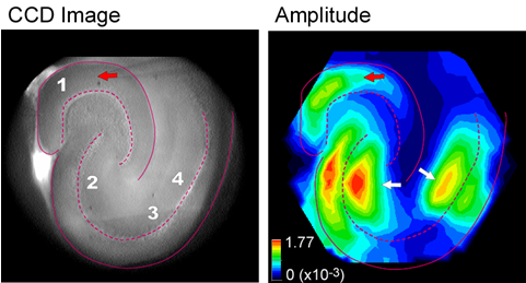 Imaging Epilepsy